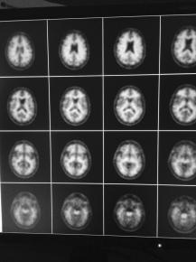Nova prova diagnstica per descartar si una persona pateix l'Alzheimer